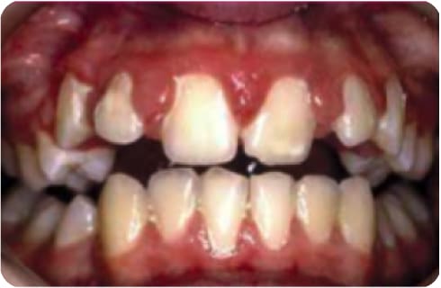 Removable Braces