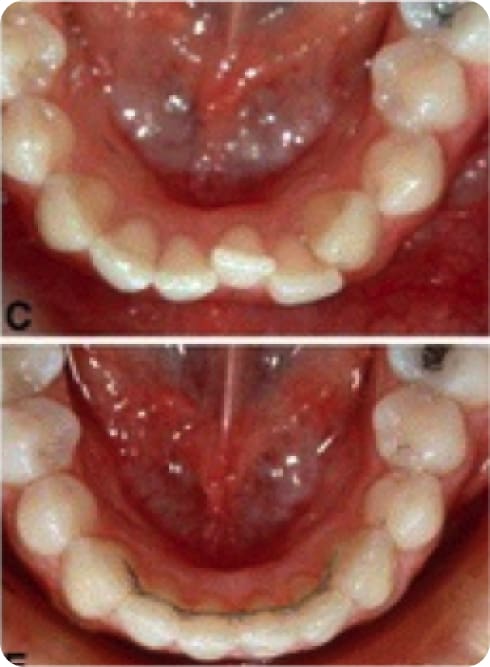 Interproximal Reduction